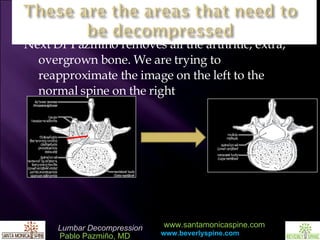 Next Dr Pazmino removes all the arthritic, extra, overgrown bone. We are trying to reapproximate the image on the left to the normal spine on the right 