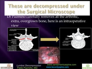 Dr Pazmino carefully removes all the arthritic, extra, overgrown bone, here is an intraoperative view 