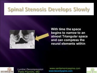 With time the space begins to narrow to an almost Triangular space and can compress the neural elements within 