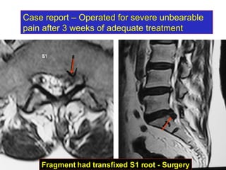 Case report – Operated for severe unbearable pain after 3 weeks of adequate treatment Fragment had transfixed S1 root - Surgery 