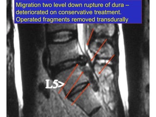 Migration two level down rupture of dura –  deteriorated on conservative treatment. Operated fragments removed transdurally 
