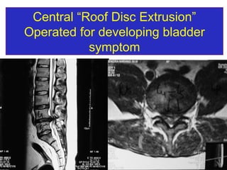 Central “Roof Disc Extrusion” Operated for developing bladder symptom 