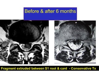 Fragment extruded between S1 root & card  - Conservative Tx Case report Mrs. W. Before & after 6 months 