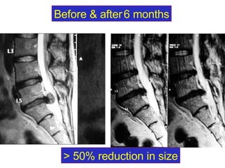 Before & after   6 months > 50% reduction in size 