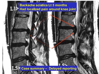 Case summary –  Delayed reporting Backache sciatica Lt 3 months Had localized pain around knee joint 