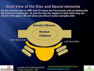 Joint Facet Nucleus  Pulposus Right Nerve Root  Left Nerve Root As you can see here on MRI and CT scans the Facet joints end up looking like the buns of a hamburger. Its just the way the happen to look when they are sliced in this plane. We will show you this on some examples later Annulus Fibrosus Axial View of the Disc and Neural elements 