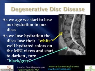 As we age we start to lose our hydration in our discs As we lose hydration the discs lose their  “ white ” well hydrated colors on the MRI views and start to darken , turn “ black/grey ” 
