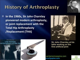 In the 1960s, Sir John Charnley pioneered modern arthroplasty,  or joint replacement with the Total Hip Arthroplasty /Replacement (THA)  Sir John Charnley at his lathe working on the first artificial joint 