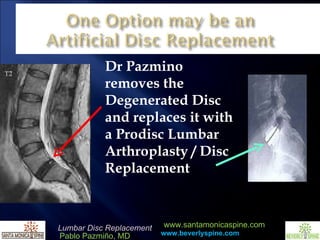 Dr Pazmino removes the Degenerated Disc and replaces it with a Prodisc Lumbar Arthroplasty / Disc Replacement  