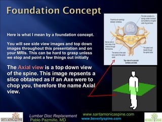 Here is what I mean by a foundation concept. You will see side view images and top down images throughout this presentation and on your MRIs. This can be hard to grasp unless we stop and point a few things out initially The  Axial view  is a top down view of the spine. This image repsents a slice obtained as if an Axe were to chop you, therefore the name Axial view. 