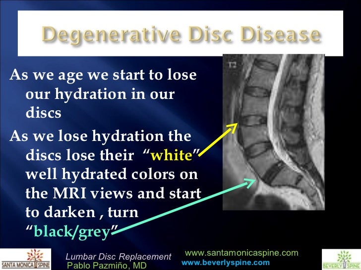 Lumbar Disc Replacement