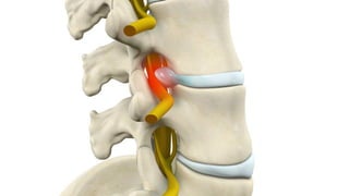 Feeling a Pinched Nerve? It Could Be Radiculopathy.