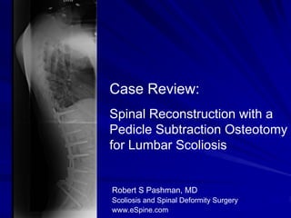 Case Review:
Spinal Reconstruction with a
Pedicle Subtraction Osteotomy
for Lumbar Scoliosis


Robert S Pashman, MD
Scoliosis and Spinal Deformity Surgery
www.eSpine.com
 