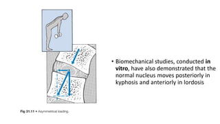 • Biomechanical studies, conducted in
vitro, have also demonstrated that the
normal nucleus moves posteriorly in
kyphosis and anteriorly in lordosis
 