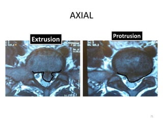 Protusion Defect LUMBAR DISC HERNIATION CAMPBELLS ORTHOPEDIC | PPTX