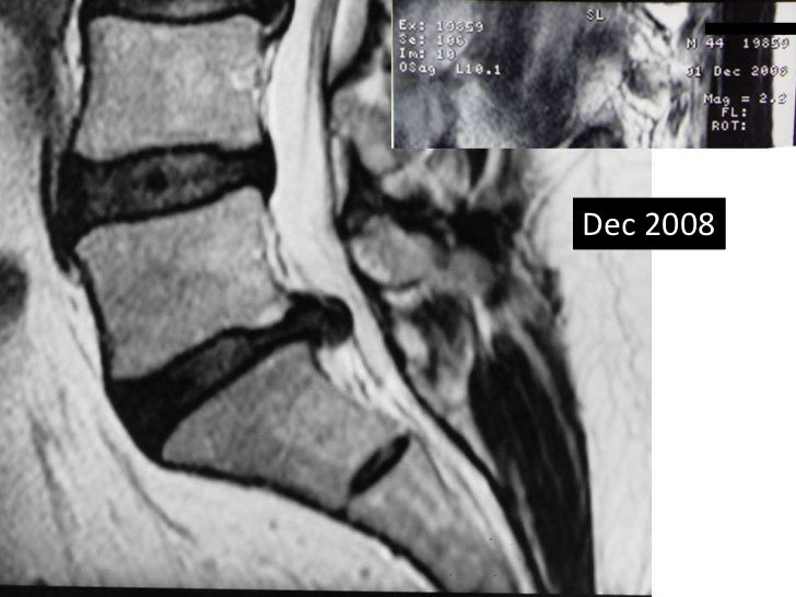 Lumbar disc extrusion clinical relation with size