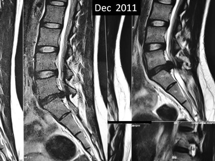 Lumbar disc extrusion clinical relation with size