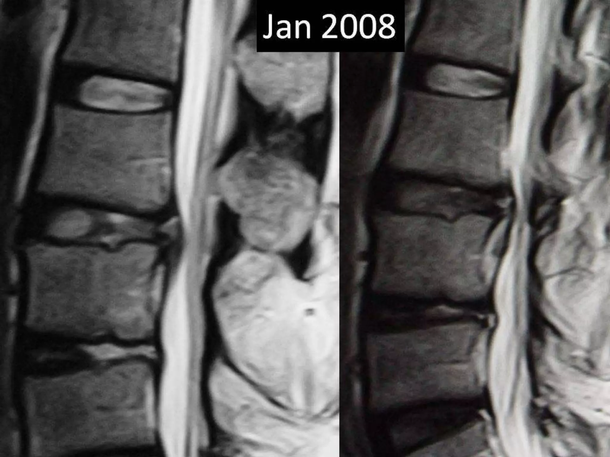 Lumbar disc extrusion –complete absorption | PPTX