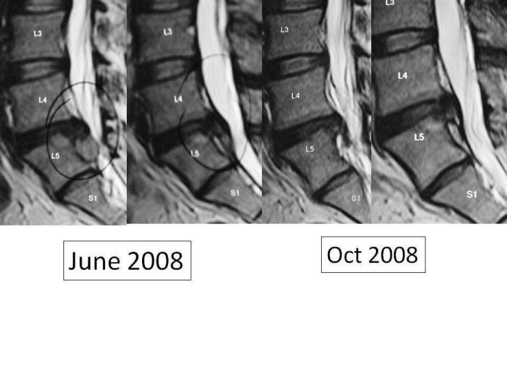 Lumbar disc extrusion recurrence