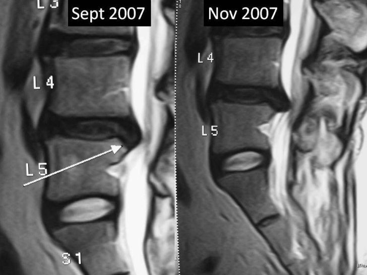 Lumbar disc extrusion recurrence