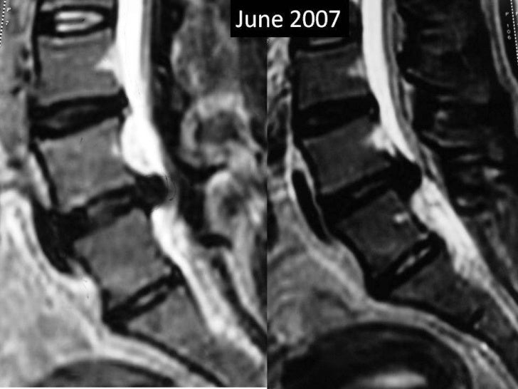 Lumbar disc extrusion recurrence