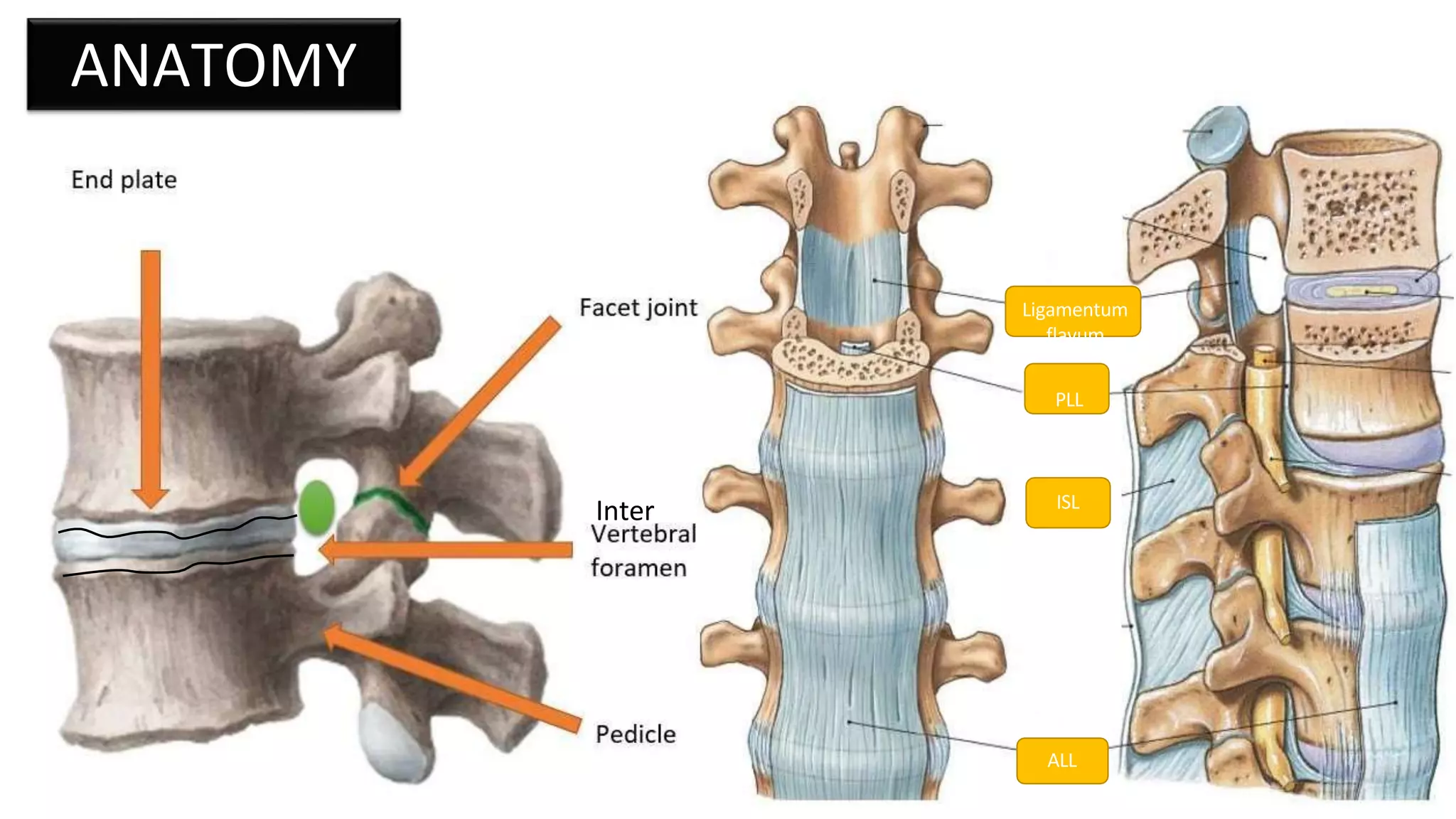 LUMBAR DISC HERNIATION.pptx