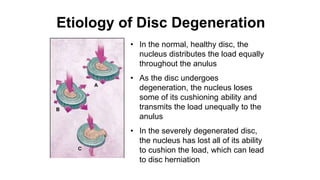 • In the normal, healthy disc, the
nucleus distributes the load equally
throughout the anulus
• As the disc undergoes
degeneration, the nucleus loses
some of its cushioning ability and
transmits the load unequally to the
anulus
• In the severely degenerated disc,
the nucleus has lost all of its ability
to cushion the load, which can lead
to disc herniation
Etiology of Disc Degeneration
 