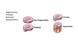 Degeneration
Prolapse
Extrusion
Sqeuestration
 