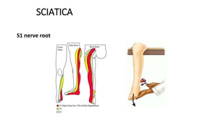 SCIATICA
S1 nerve root
 