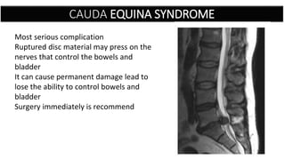 CAUDA EQUINA SYNDROME
Most serious complication
Ruptured disc material may press on the
nerves that control the bowels and
bladder
It can cause permanent damage lead to
lose the ability to control bowels and
bladder
Surgery immediately is recommend
 
