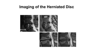 Imaging of the Herniated Disc
 