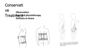 Conservati
ve
Treatment
Observation
Rest and physiotherapy
Orthosis or brace
 