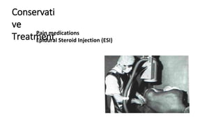 Conservati
ve
Treatment
Pain medications
Epidural Steroid Injection (ESI)
 