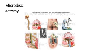 Microdisc
ectomy
 