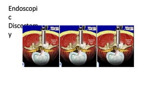 Endoscopi
c
Discectom
y
 