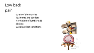 Low back
pain
strain of the muscles
ligaments and tendons
Herniation of lumbar disc
sciatica
Various other conditions
 