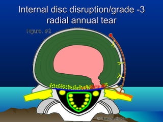 Lumbar disc presentation dr ajay bajaj neurosurgeon | PPT