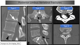 Disc Prolapse Classification Lumbar Disc prolapse - Basics.pptx