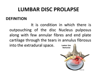 Lumbar disc prolapse | PPT