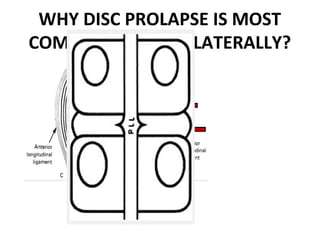 Disc Prolapse Classification Lumbar disc prolapse | PPT