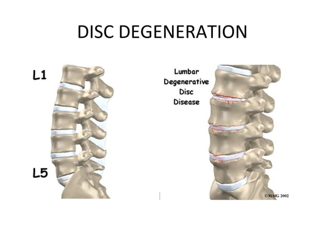 Disc Prolapse Classification lumbardiscprolapse3-130219095421-phpapp01 (1).pdf
