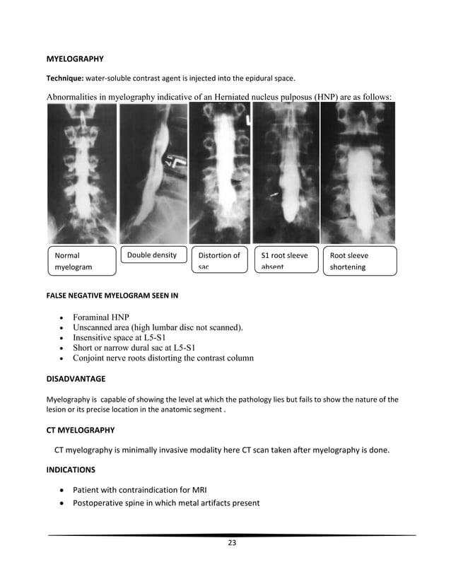 Lumbar disc prolapse