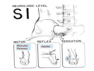 S1
Aquileo
Músculos
Peroneos
 