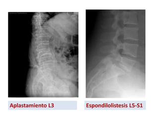 Aplastamiento L3 Espondilolistesis L5-S1
 