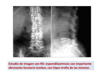 Estudio de imagen con RX: espondiloartrosis con importante
afectación facetaria lumbar, con hiper-trofia de las mismas.
 