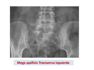Mega apófisis Transversa Izquierda
 