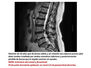 Paciente de 54 años que de forma súbita y sin relación con esfuerzo previo sufre
dolor lumbar irradiado por ambos miembros inferiores y posteriormente
pérdida de fuerza que le impide caminar sin ayudas.
RMN: Estenosis del canal y foraminal.
Protrusión herniaria epidural, en nivel L3-L4 paracentral derecha.
 