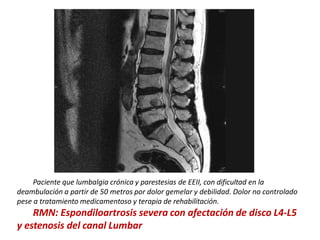 Paciente que lumbalgia crónica y parestesias de EEII, con dificultad en la
deambulación a partir de 50 metros por dolor gemelar y debilidad. Dolor no controlado
pese a tratamiento medicamentoso y terapia de rehabilitación.
RMN: Espondiloartrosis severa con afectación de disco L4-L5
y estenosis del canal Lumbar
 