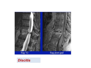 Discitis
 