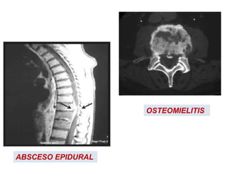 ABSCESO EPIDURAL
OSTEOMIELITIS
 